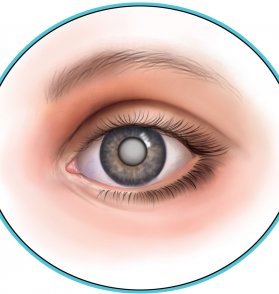Что необходимо знать о катаракте