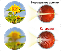 лечение катаракты в херсоне